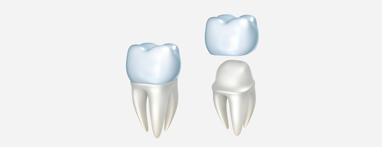 Same-day crowns