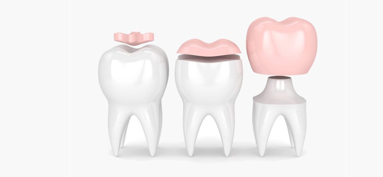 What You Need To Know About Dental Inlays and Onlays