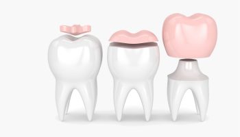 What You Need To Know About Dental Inlays and Onlays