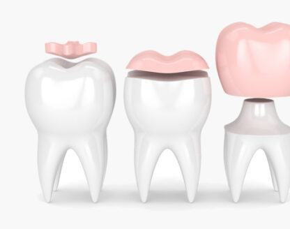 What You Need To Know About Dental Inlays and Onlays 