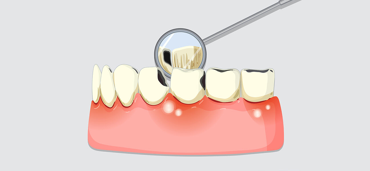 What is Perio Protect Treatment? The Basics Explained