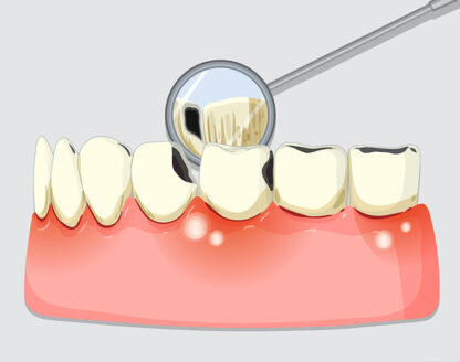 What is Perio Protect Treatment? The Basics Explained 