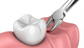 How to Stop Bleeding After Tooth Extraction Without Causing a Dry Socket