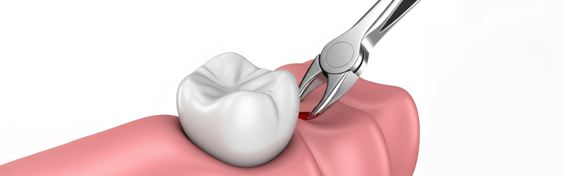 How to Stop Bleeding After Tooth Extraction Without Causing a Dry Socket