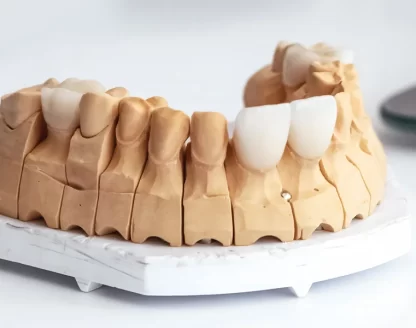 Why-Oral-Hygiene-Matters-Can-Teeth-Decay-Under-Veneers 