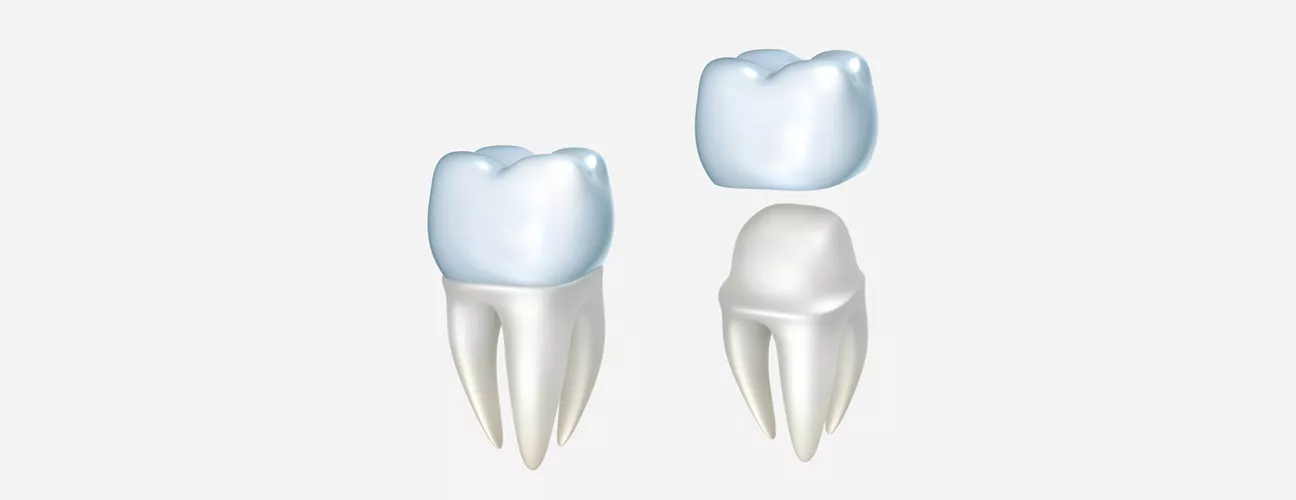 Same Day Crowns